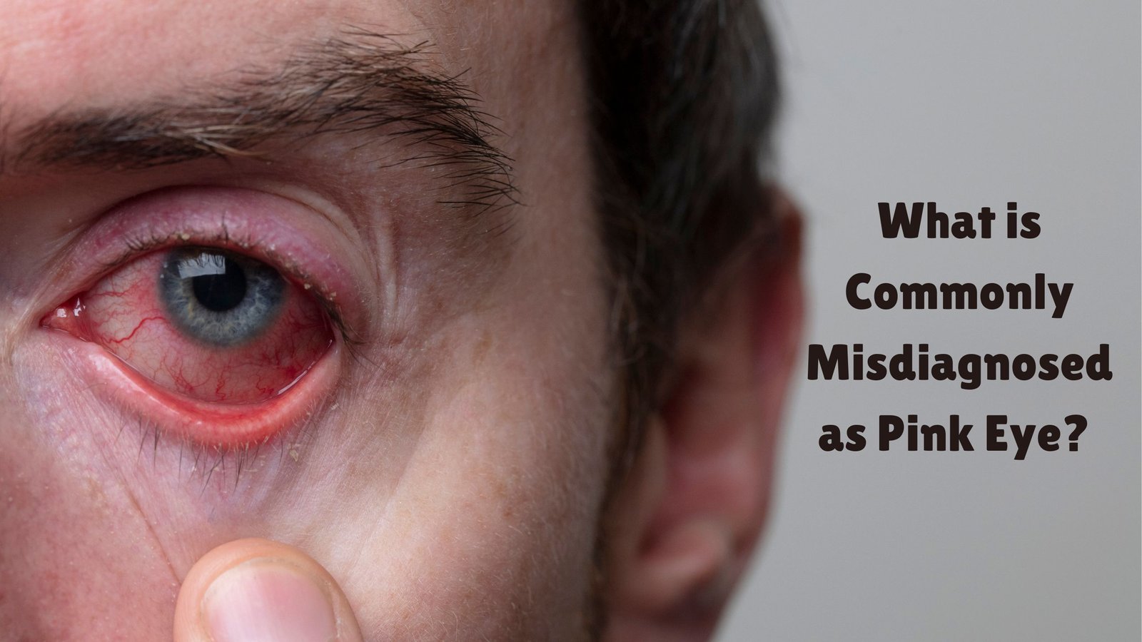 Commonly Misdiagnosed as Pink Eye