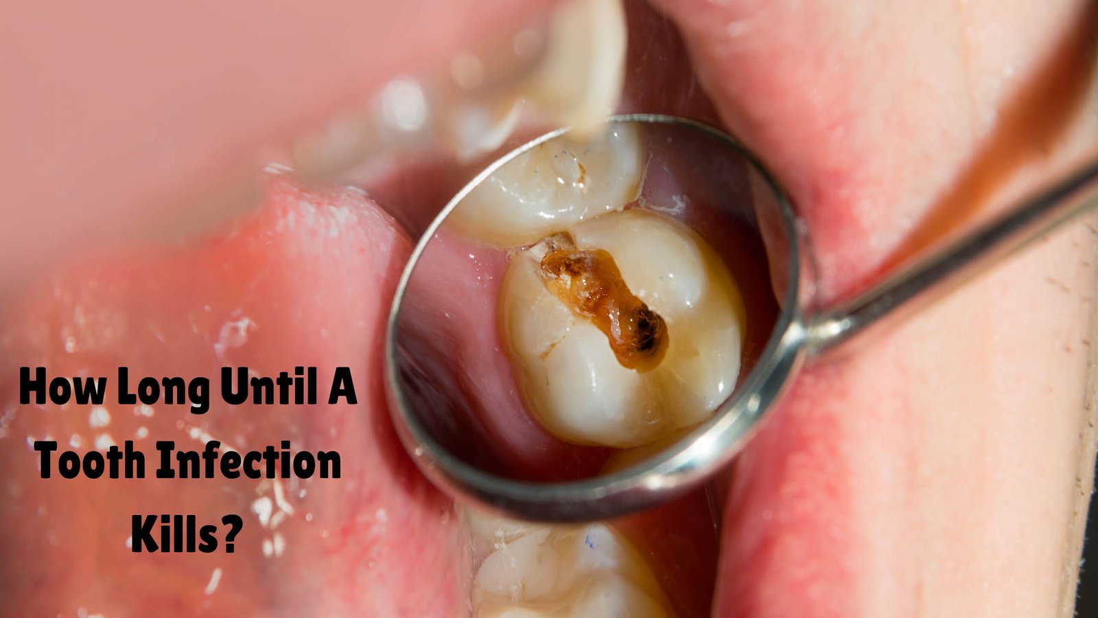 How long until a tooth infection kills you